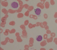 Малые лимфоциты через микроскоп